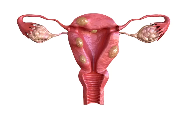 Fibrom Uterin. Cum se tratează fibromul uterin?