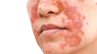 Dermatita seboreică: Cauze, simptome și tratament eficient