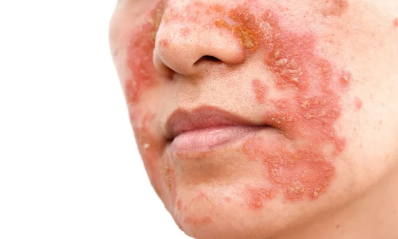 Dermatita seboreică: Cauze, simptome și tratament eficient 1 Dermatita seboreică: Cauze, simptome și tratament eficient