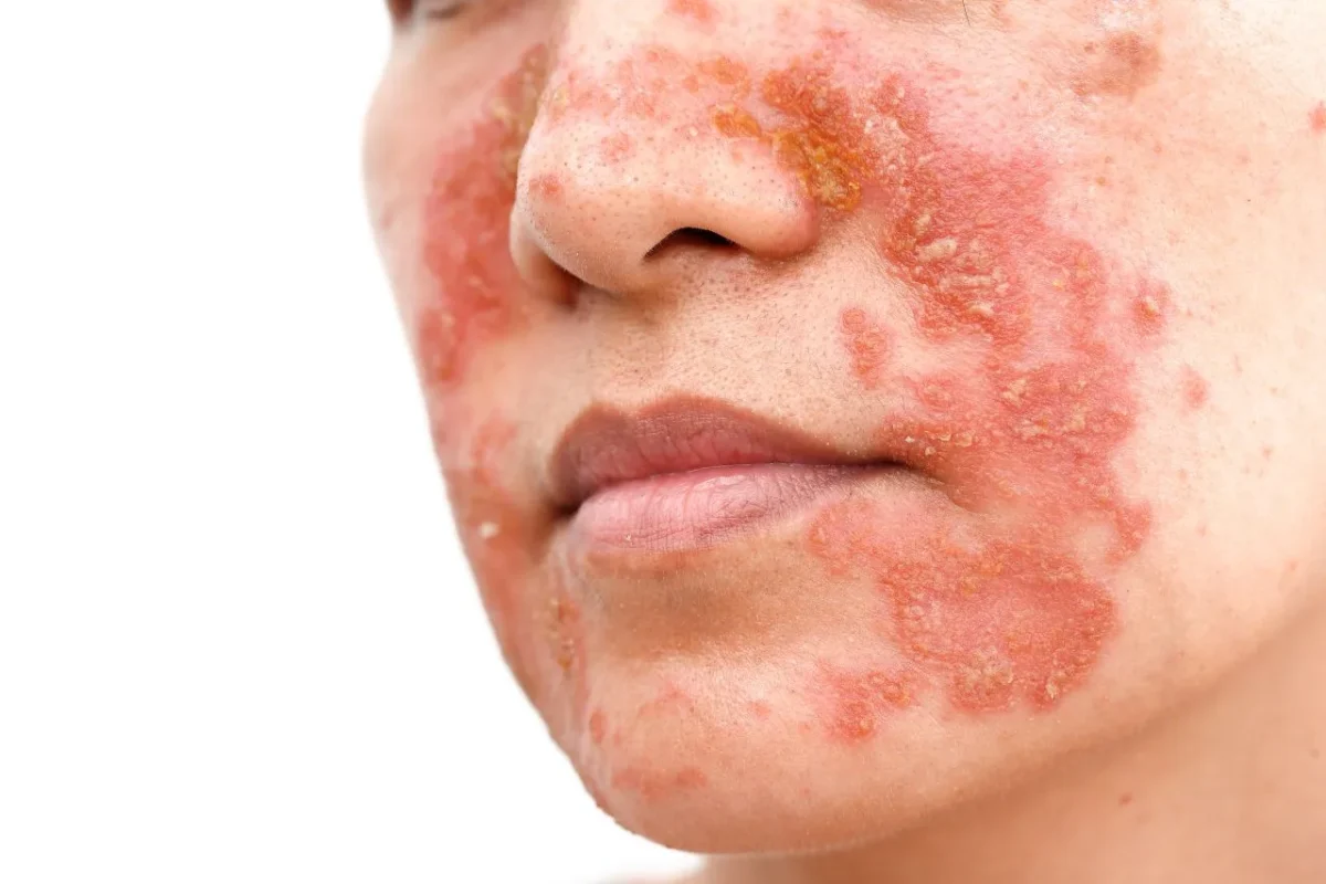 Dermatita seboreică: Cauze, simptome și tratament eficient 1 Dermatita seboreică: Cauze, simptome și tratament eficient