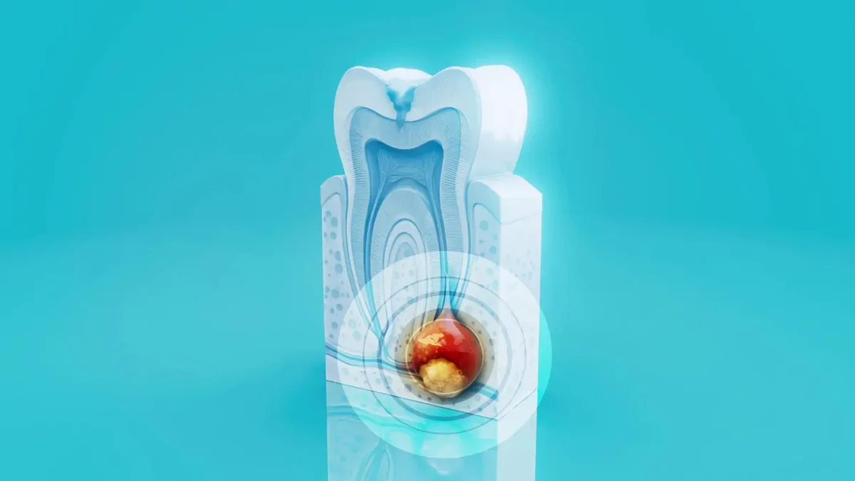 Abces dentar: cauze, simptome, tratament și semnele care cer urgență medicală